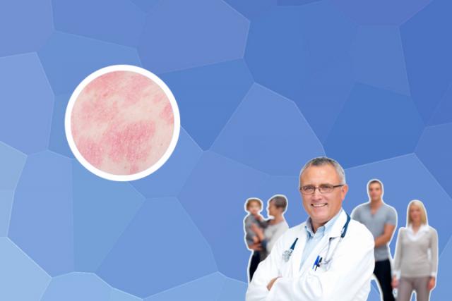 牛皮癣摸起来硬了是怎么回事-什么癣皮肤是硬的