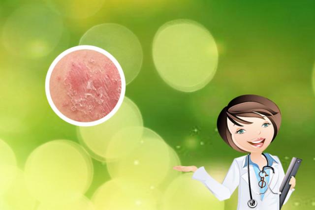 银屑病到底能治好吗-银屑病容易治好吗