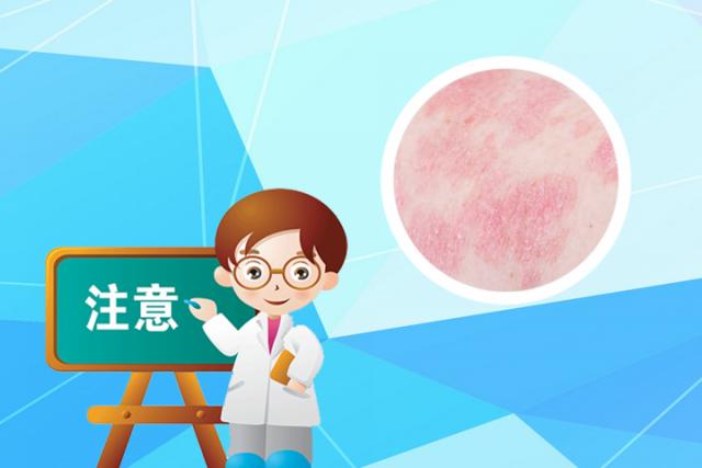 兰州治银屑病哪里好