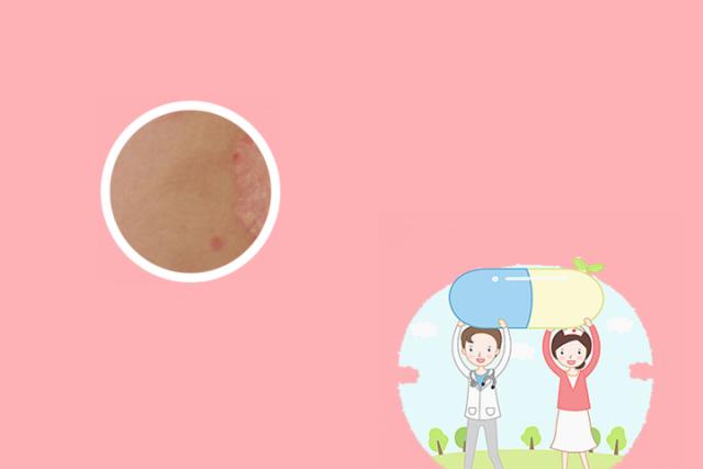 兰州哪里医院治银屑病效果好