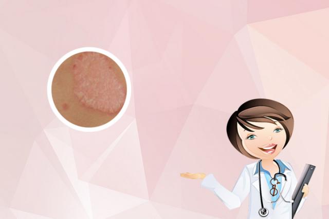 兰州银屑病医院：梅涛医生-银屑病可以用白醋治疗吗