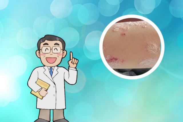 兰州银屑病医院：杨利兵医生-银屑病患者如何正确洗头？