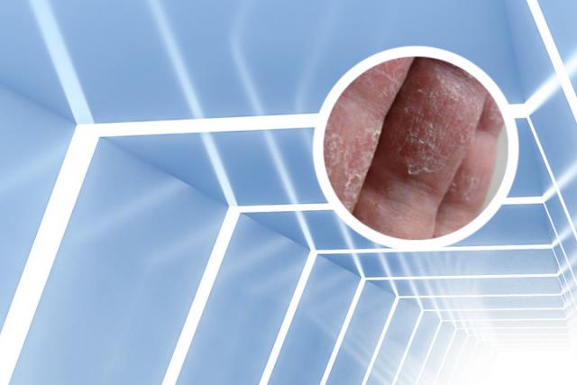 兰州银屑病医院：杨利兵医生-银屑病不要滥用哪两类药品？