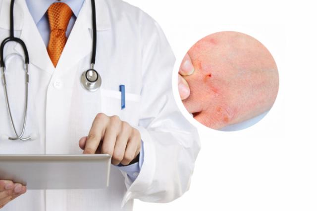 兰州银屑病医院：王琳娜医生-银屑病夏季治疗的优势