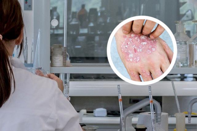 兰州银屑病医院：梅涛医生-银屑病专项检查的必要性