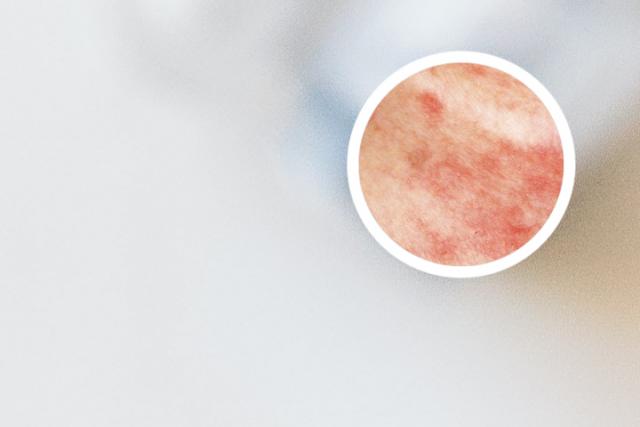 皮癣怎样才好得快