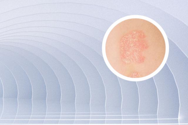 甘肃哪里有看银屑病的医院