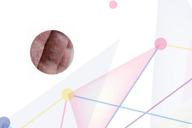 兰州哪治银屑病医院