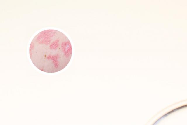 牛皮肤癣怎么根治