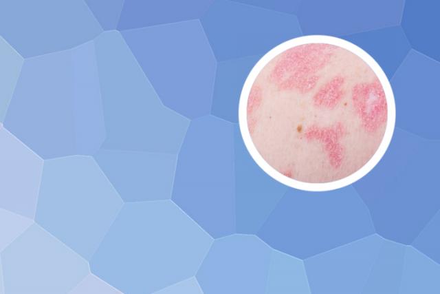 2022攻克银屑病的最新进展