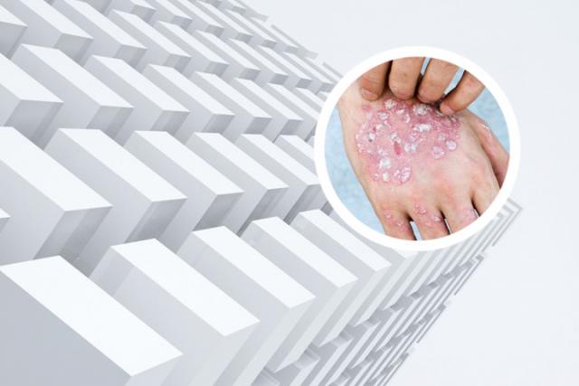 兰州什么医院专治银屑病