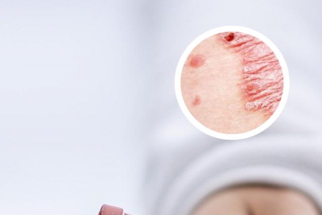 兰州哪家牛皮癣医院比较有名