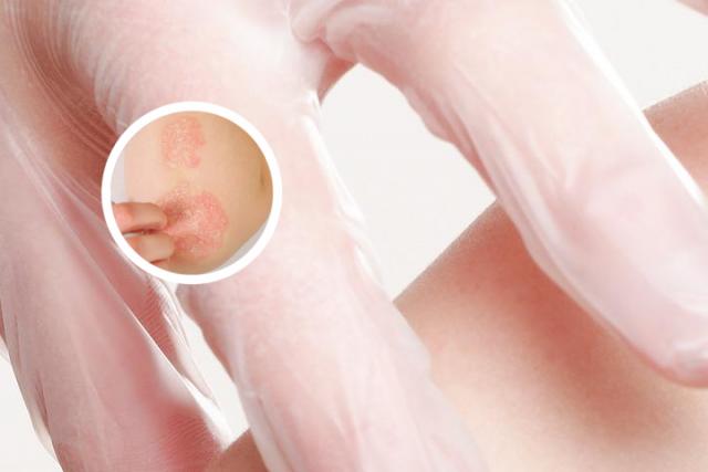 金昌哪家医院治疗银屑病