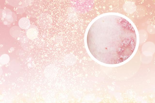 甘肃银屑病找哪家