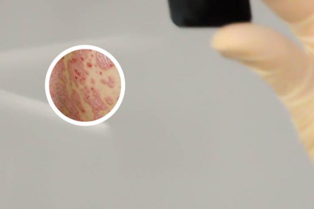 银屑病手指关节痛是怎么回事