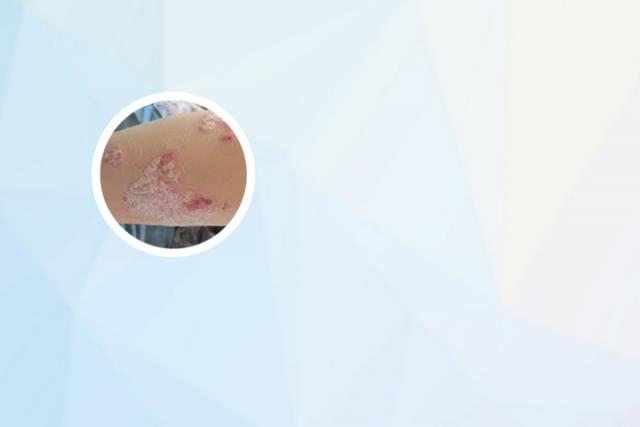 父亲有银屑病遗传女儿概率