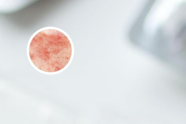 甘肃哪家医院治疗牛皮癣比较好