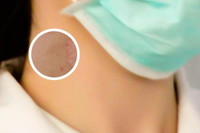 皮肤干燥脱屑像雪花怎么办