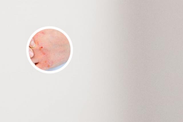 银屑病图片 初期