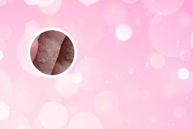 治疗头皮银皮癣最有效的药