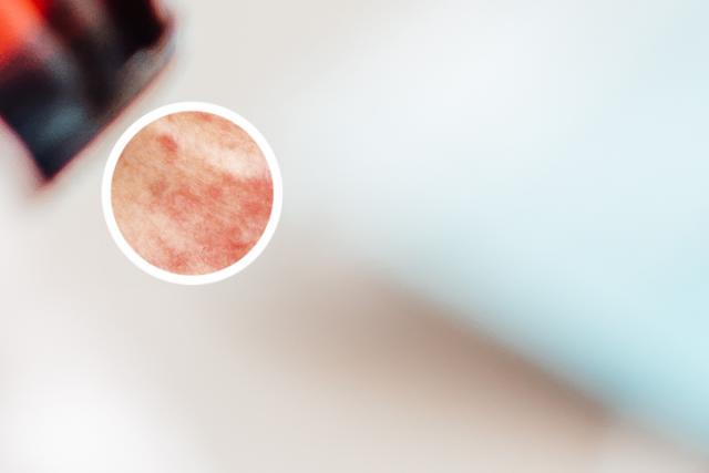 天水银屑病该如何治疗