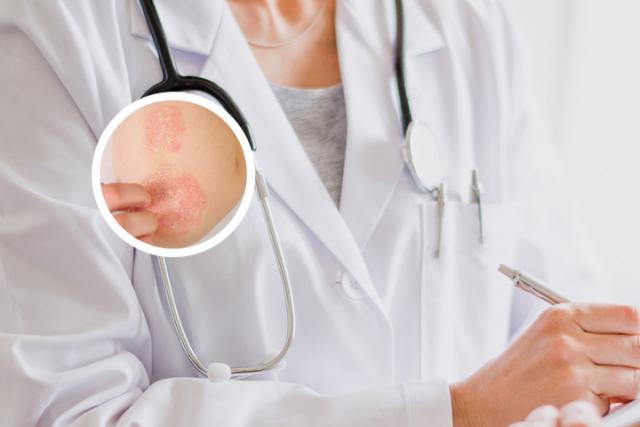 兰州能治银屑病的医院