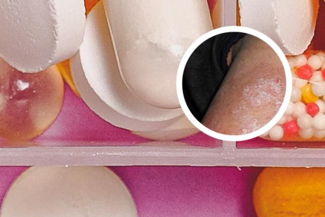 甘肃哪家医院治疗银屑病强