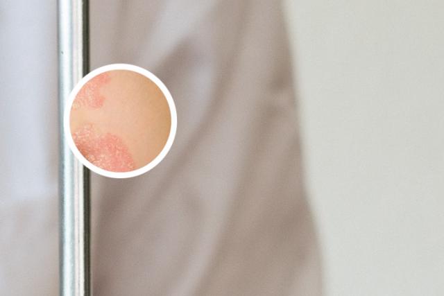 甘肃治疗银屑病最好医院