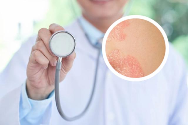 兰州银屑病哪家治疗好
