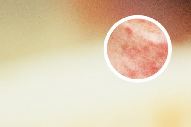 掌指脓包病是什么意思