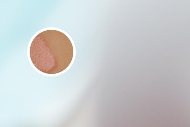 掌跖脓疱病严重吗