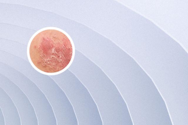 银屑头皮用什么药治疗