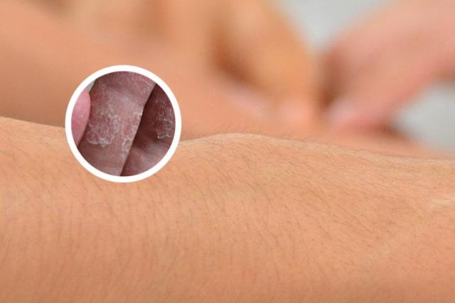 银屑病是怎么来的