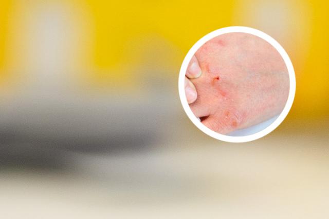 银屑病可以染发烫发吗