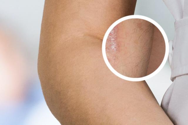 银屑病可以烫头发染头发吗