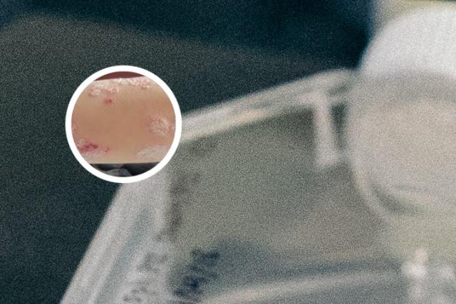 头皮上长癣怎么治