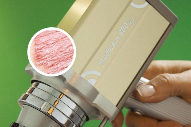 银屑病民间小偏方