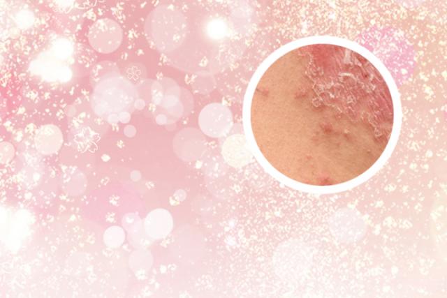 治疗银屑病最有效的药