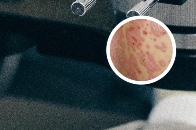 银屑病图片症状