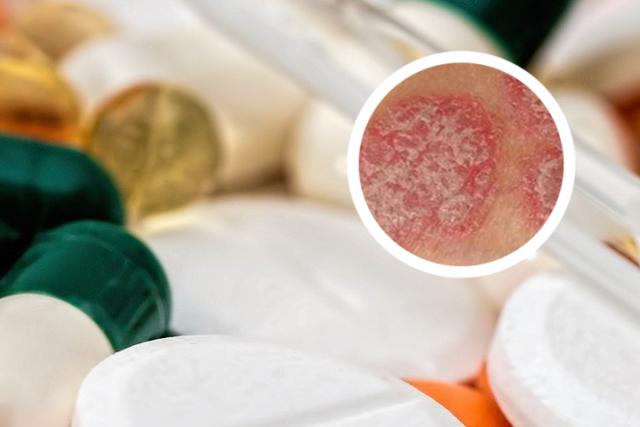 银屑病为什么会得