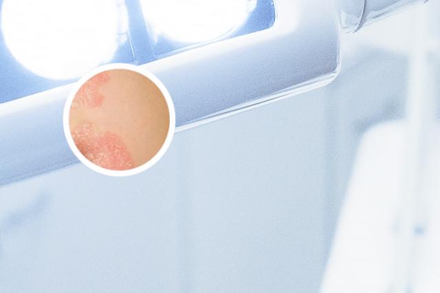 银屑病关节炎诊断标准