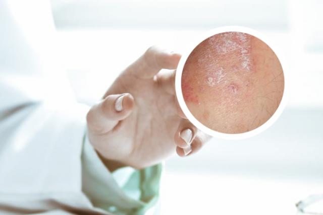 头皮银屑病传染吗