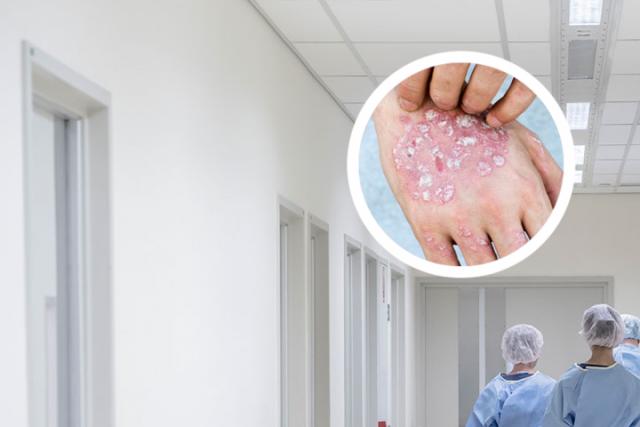 银屑病关节炎用什么好药来治