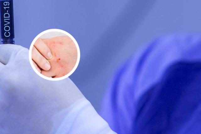 银屑病关节炎到老了会严重吗