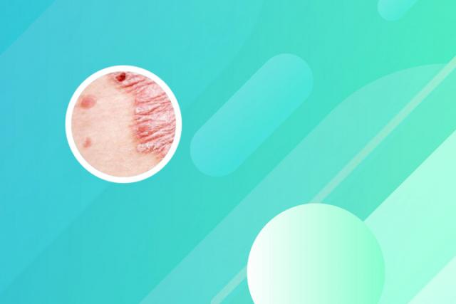 头部银屑病恢复过程