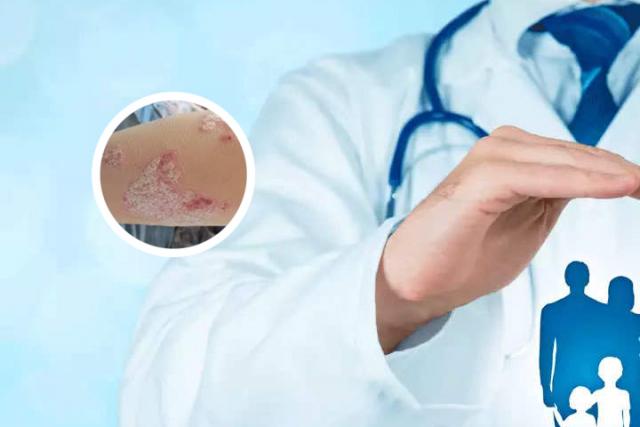 指甲银屑病会自愈吗