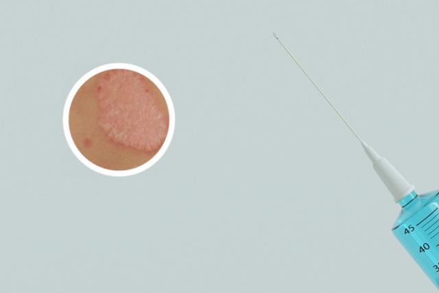 什么叫银屑病晚期症状