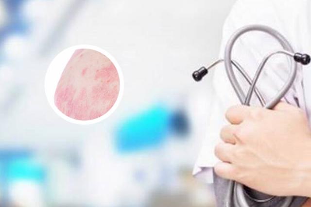 女人得银屑病多吗