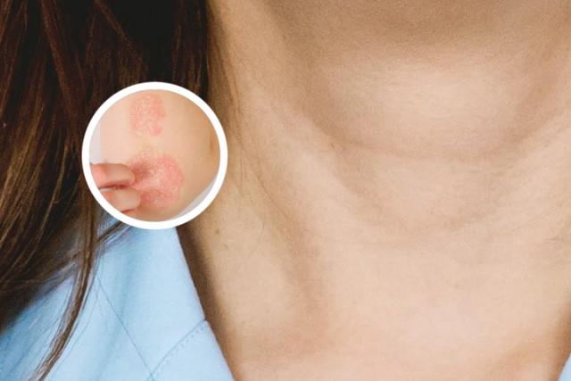 请问银屑病人吃什么药比较好