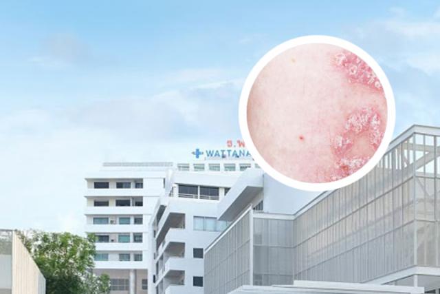 干细胞治银屑病新进展